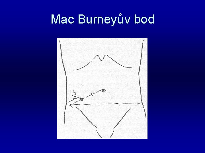 Mac Burneyův bod 