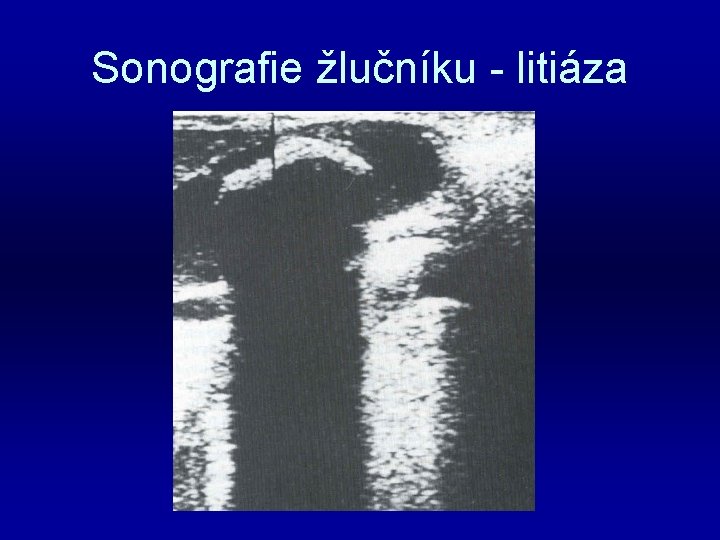 Sonografie žlučníku - litiáza 