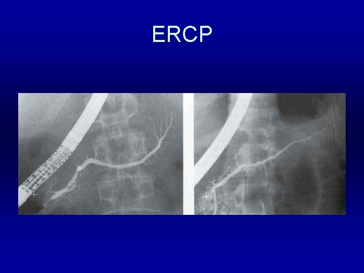 ERCP 