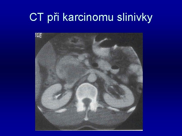 CT při karcinomu slinivky 