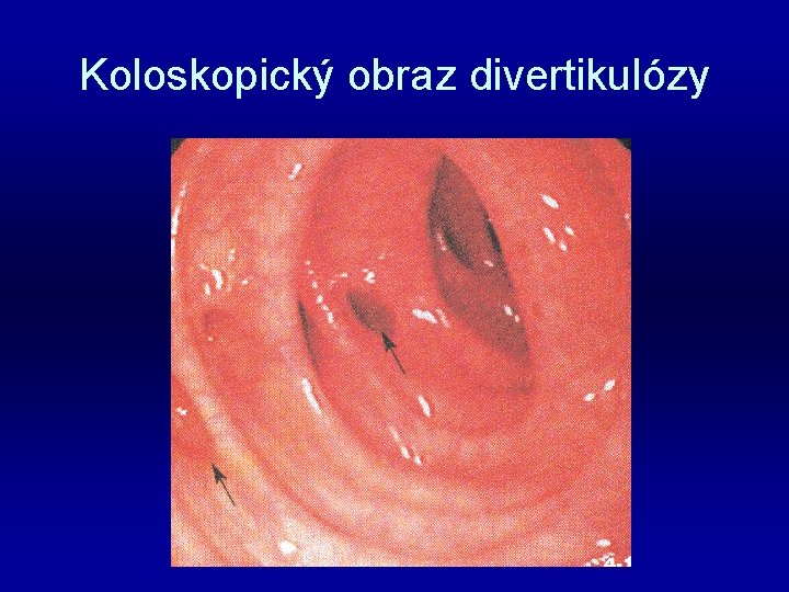 Koloskopický obraz divertikulózy 