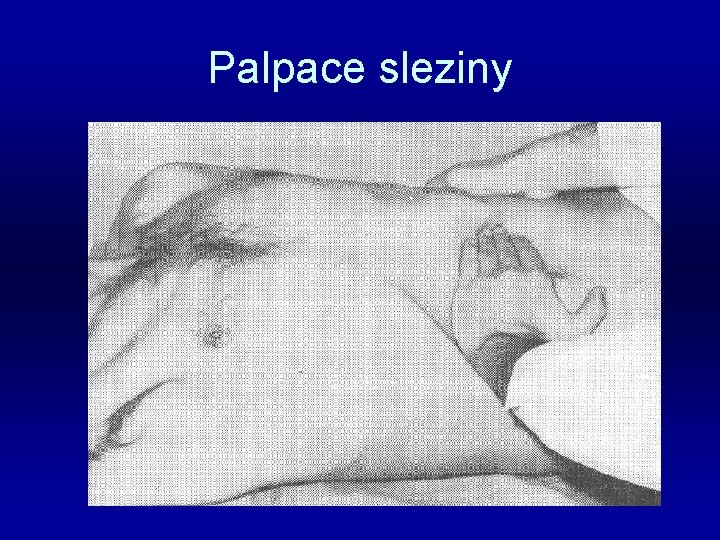 Palpace sleziny 