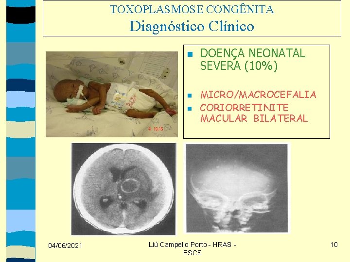 TOXOPLASMOSE CONGÊNITA Diagnóstico Clínico 04/06/2021 DOENÇA NEONATAL SEVERA (10%) MICRO/MACROCEFALIA CORIORRETINITE MACULAR BILATERAL Liú