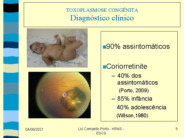 TOXOPLASMOSE CONGÊNITA Diagnóstico clínico 90% assintomáticos Coriorretinite – 40% dos assintomáticos (Porto, 2009) –