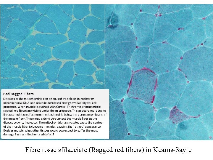 Fibre rosse sfilacciate (Ragged red fibers) in Kearns-Sayre 