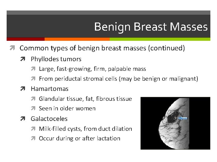 Benign Breast Masses Common types of benign breast masses (continued) Phyllodes tumors Large, fast-growing,