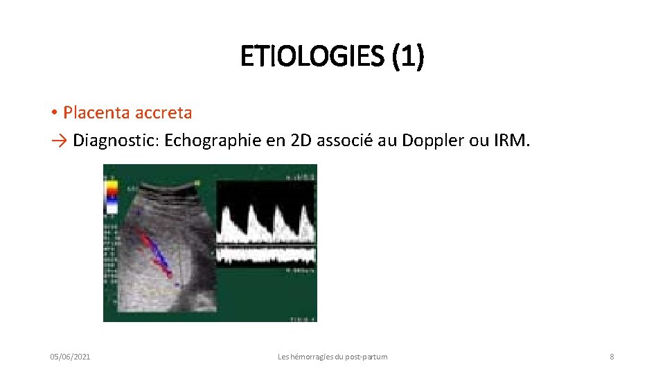 ETIOLOGIES (1) • Placenta accreta → Diagnostic: Echographie en 2 D associé au Doppler