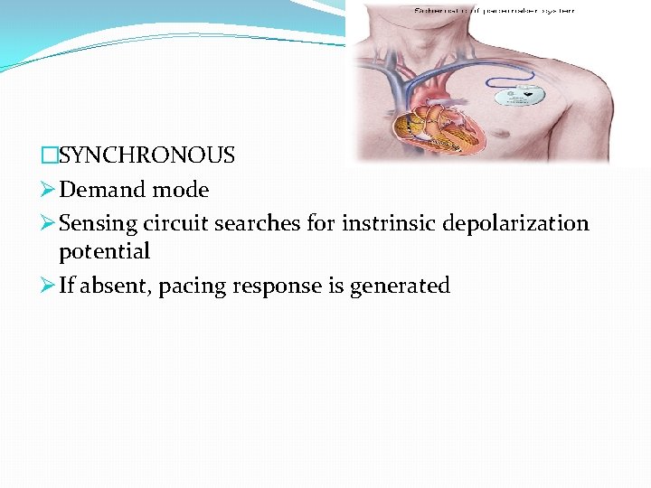 �SYNCHRONOUS Ø Demand mode Ø Sensing circuit searches for instrinsic depolarization potential Ø If