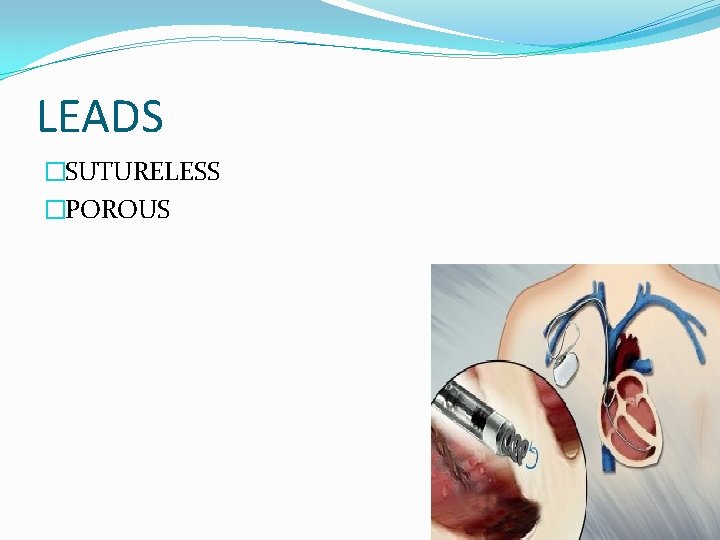 LEADS �SUTURELESS �POROUS 