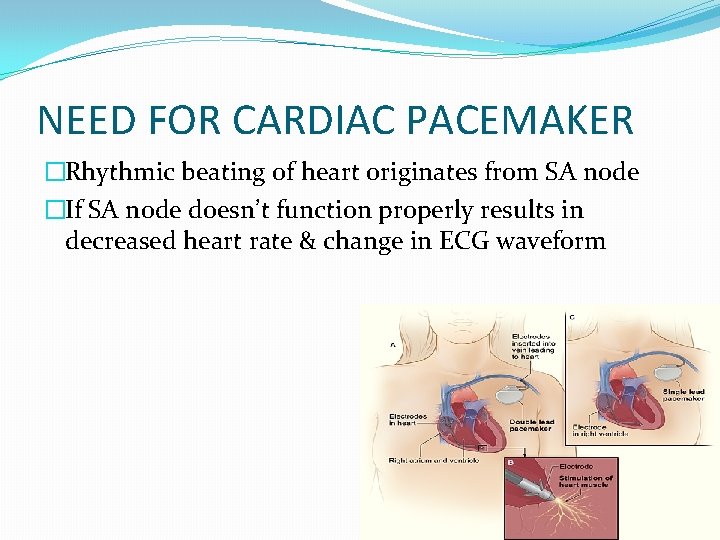 NEED FOR CARDIAC PACEMAKER �Rhythmic beating of heart originates from SA node �If SA