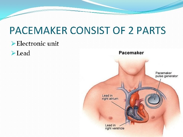 PACEMAKER CONSIST OF 2 PARTS Ø Electronic unit Ø Lead 