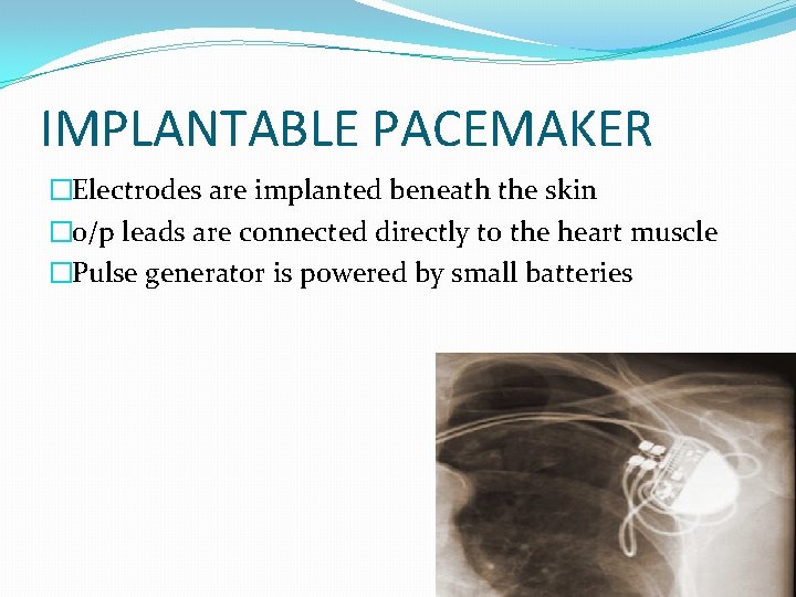 IMPLANTABLE PACEMAKER �Electrodes are implanted beneath the skin �o/p leads are connected directly to