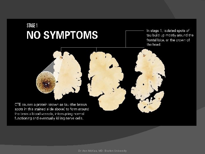 Dr Ann Mc. Kee, MD- Boston University 