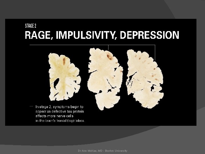 Dr Ann Mc. Kee, MD - Boston University 