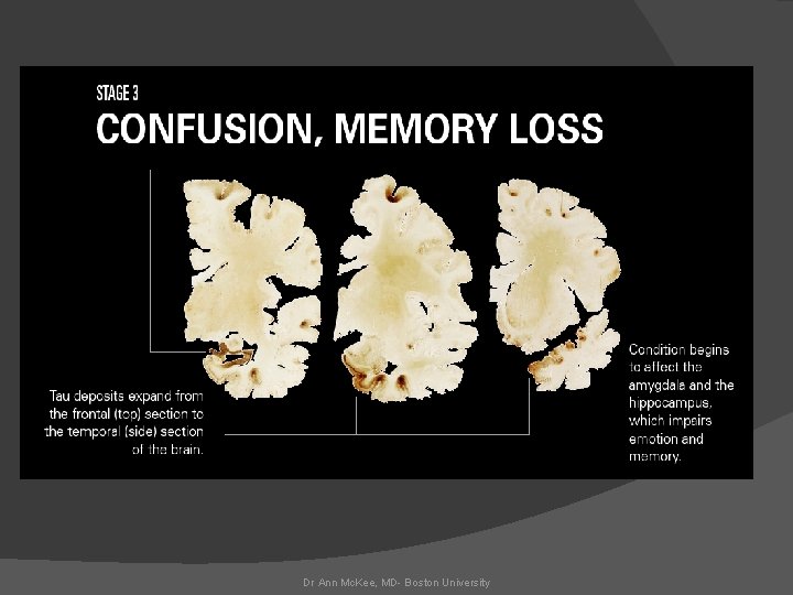 Dr Ann Mc. Kee, MD- Boston University 