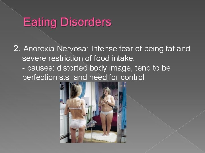 Eating Disorders 2. Anorexia Nervosa: Intense fear of being fat and severe restriction of