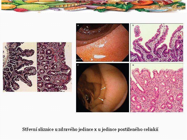 15 Střevní sliznice u zdravého jedince x u jedince postiženého celiakií 