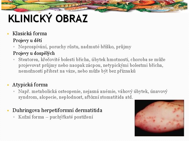 16 KLINICKÝ OBRAZ • Klasická forma Projevy u dětí ▫ Neprospívání, poruchy růstu, nadmuté