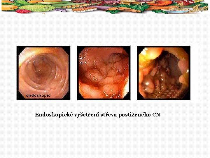 28 Endoskopické vyšetření střeva postiženého CN 