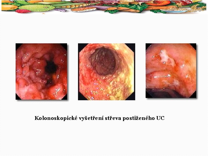 31 Kolonoskopické vyšetření střeva postiženého UC 