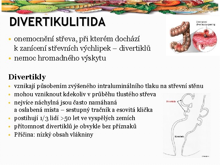 56 DIVERTIKULITIDA • onemocnění střeva, při kterém dochází k zanícení střevních výchlipek – divertiklů