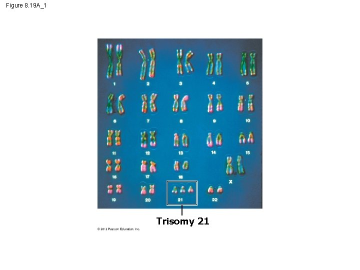 Figure 8. 19 A_1 Trisomy 21 
