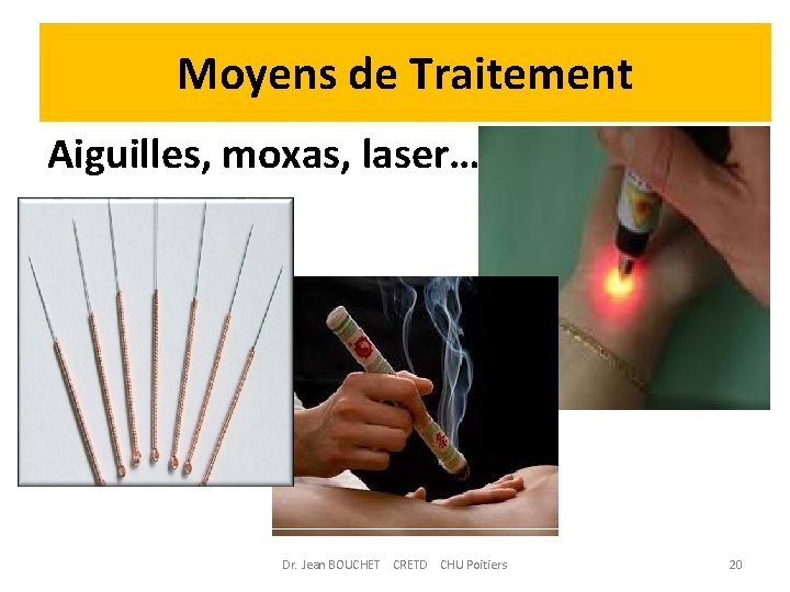 Moyens de Traitement Aiguilles, moxas, laser… Dr. Jean BOUCHET CRETD CHU Poitiers 20 