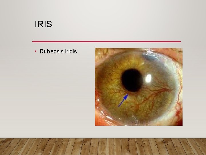 IRIS • Rubeosis iridis. 