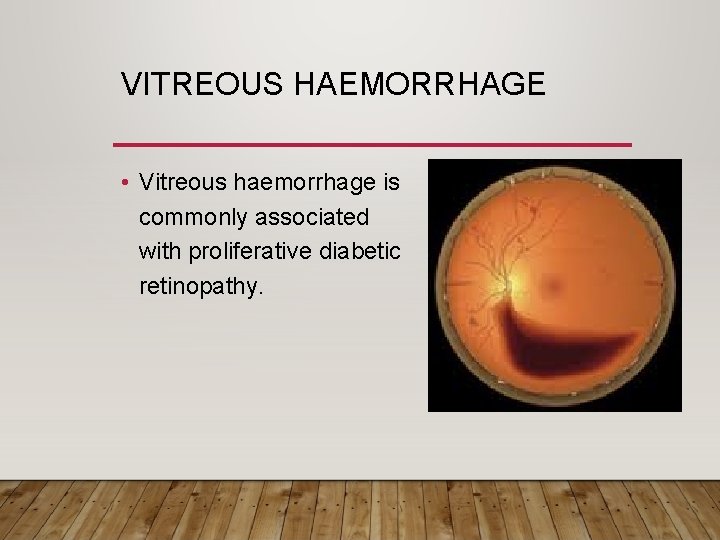 VITREOUS HAEMORRHAGE • Vitreous haemorrhage is commonly associated with proliferative diabetic retinopathy. 