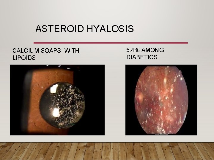 ASTEROID HYALOSIS CALCIUM SOAPS WITH LIPOIDS 5. 4% AMONG DIABETICS 