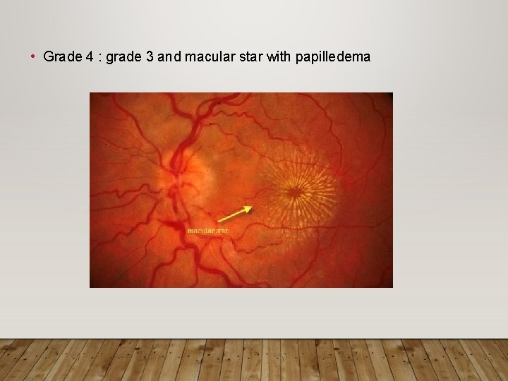  • Grade 4 : grade 3 and macular star with papilledema 