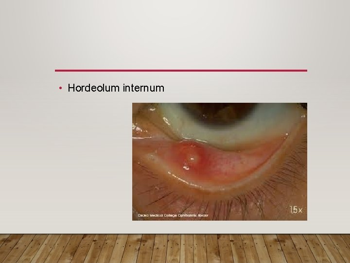  • Hordeolum internum 