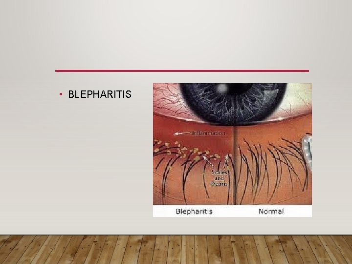  • BLEPHARITIS 