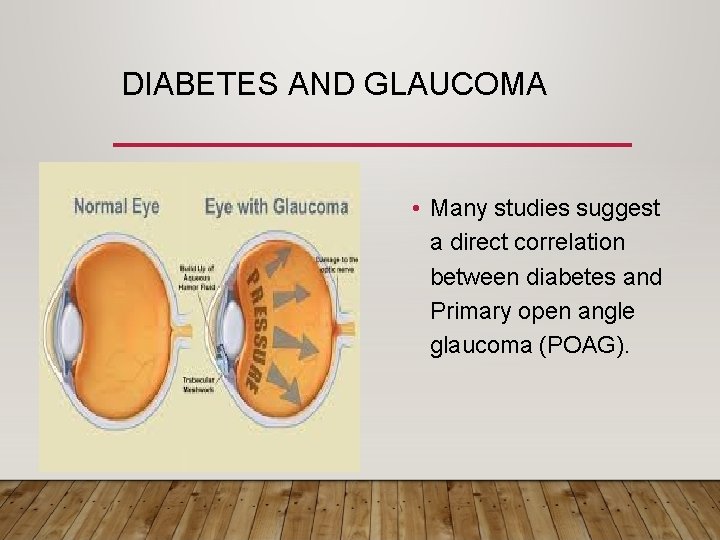 DIABETES AND GLAUCOMA • Many studies suggest a direct correlation between diabetes and Primary