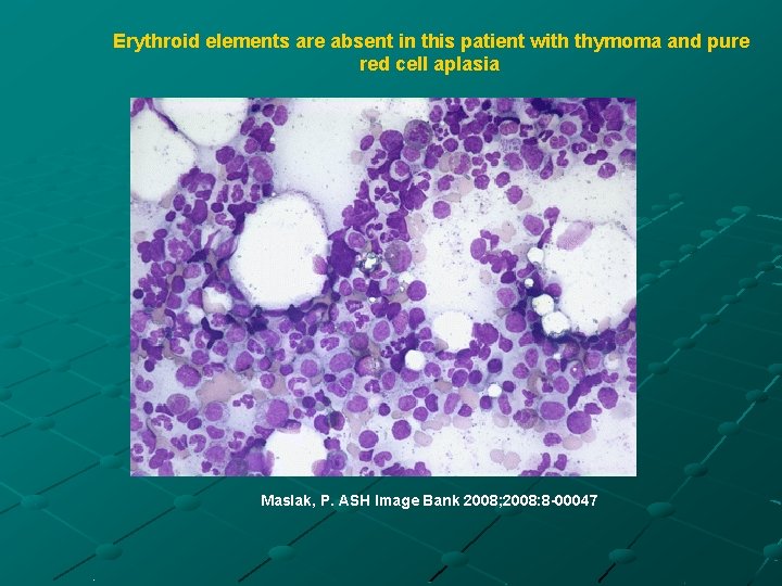 Erythroid elements are absent in this patient with thymoma and pure red cell aplasia