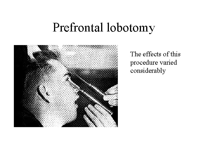 Prefrontal lobotomy The effects of this procedure varied considerably 