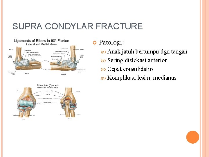 SUPRA CONDYLAR FRACTURE Patologi: Anak jatuh bertumpu dgn tangan Sering dislokasi anterior Cepat consulidatio
