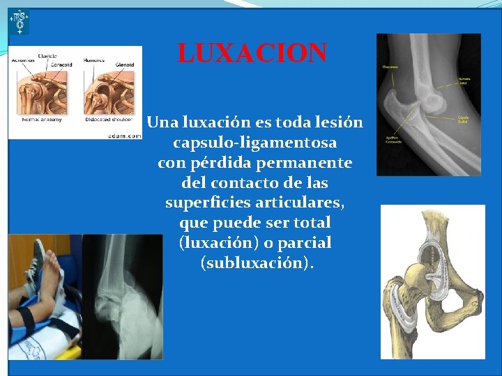 LUXACION Una luxación es toda lesión capsulo-ligamentosa con pérdida permanente del contacto de las
