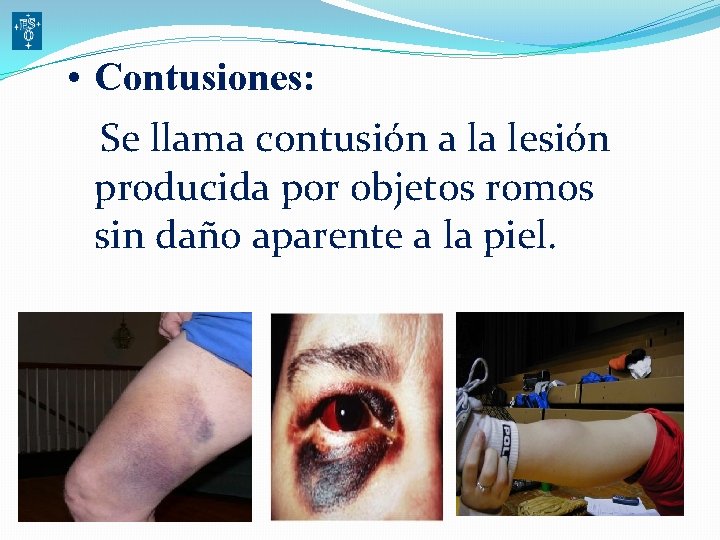  • Contusiones: Se llama contusión a la lesión producida por objetos romos sin