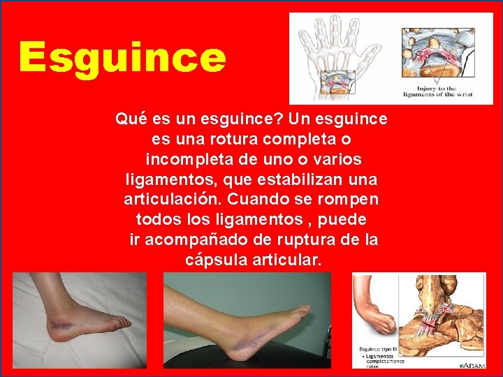 Esguince Qué es un esguince? Un esguince es una rotura completa o incompleta de