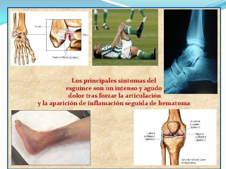 Los principales síntomas del esguince son un intenso y agudo dolor tras forzar la