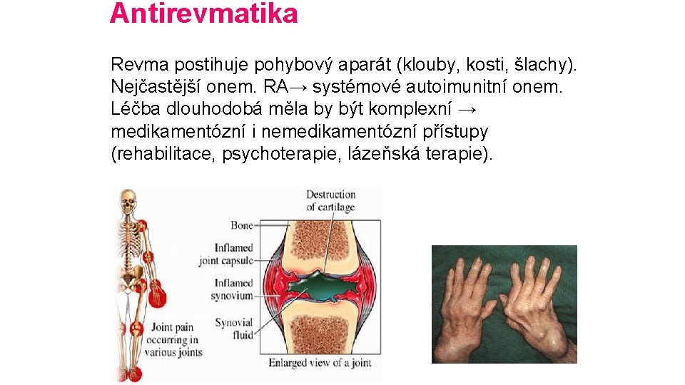 Antirevmatika Revma postihuje pohybový aparát (klouby, kosti, šlachy). Nejčastější onem. RA→ systémové autoimunitní onem.