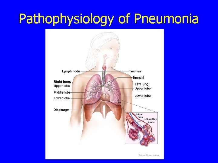 Pathophysiology of Pneumonia 