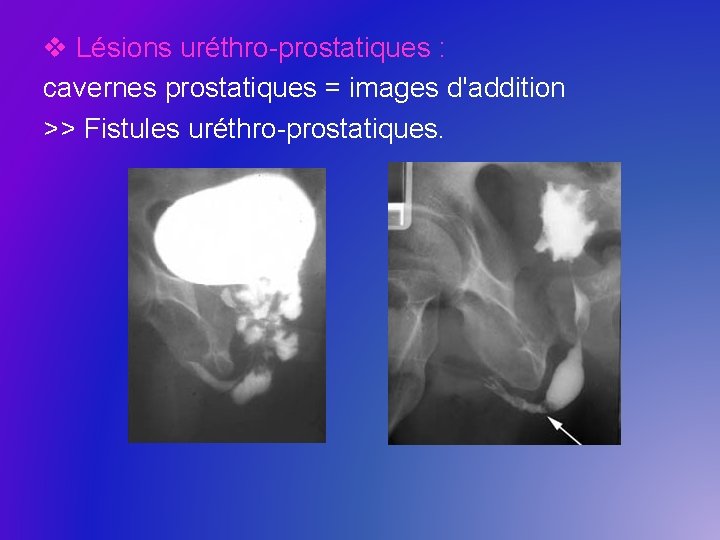 v Lésions uréthro-prostatiques : cavernes prostatiques = images d'addition >> Fistules uréthro-prostatiques. 