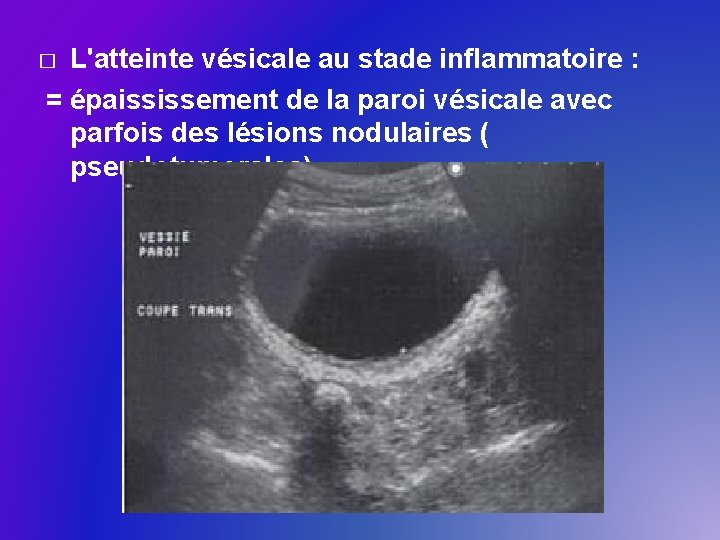 L'atteinte vésicale au stade inflammatoire : = épaississement de la paroi vésicale avec parfois