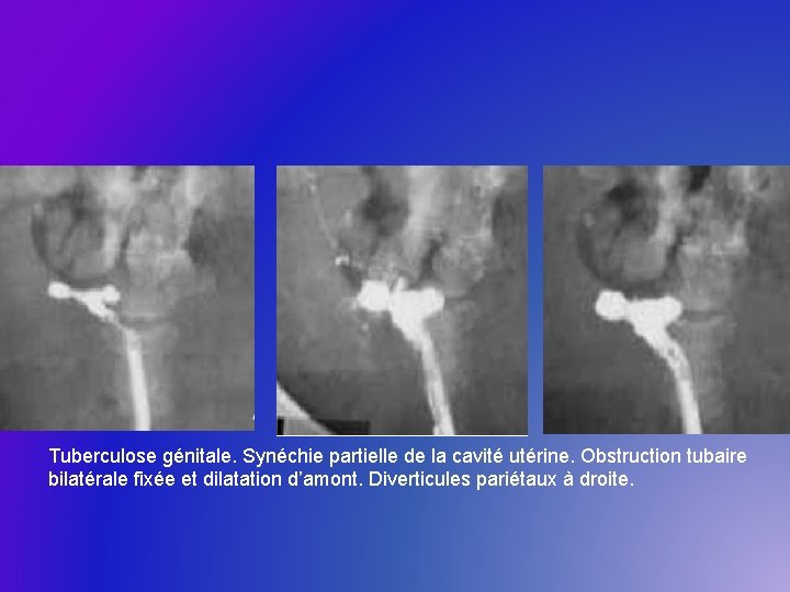 Tuberculose génitale. Synéchie partielle de la cavité utérine. Obstruction tubaire bilatérale fixée et dilatation