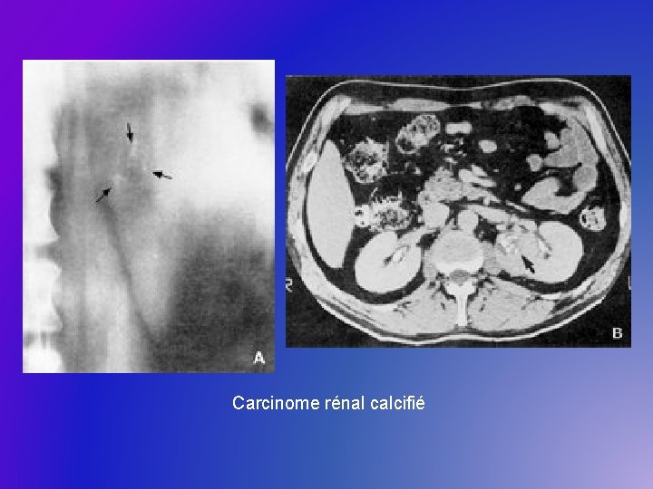 Carcinome rénal calcifié 