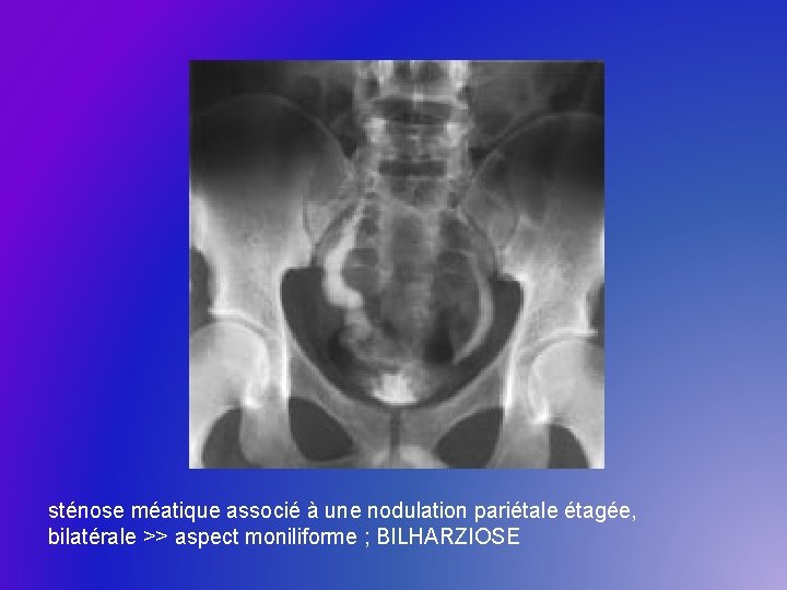 sténose méatique associé à une nodulation pariétale étagée, bilatérale >> aspect moniliforme ; BILHARZIOSE