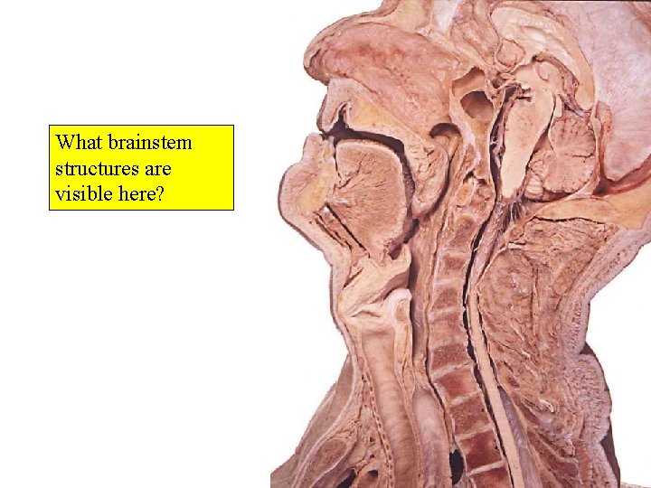 What brainstem structures are visible here? 