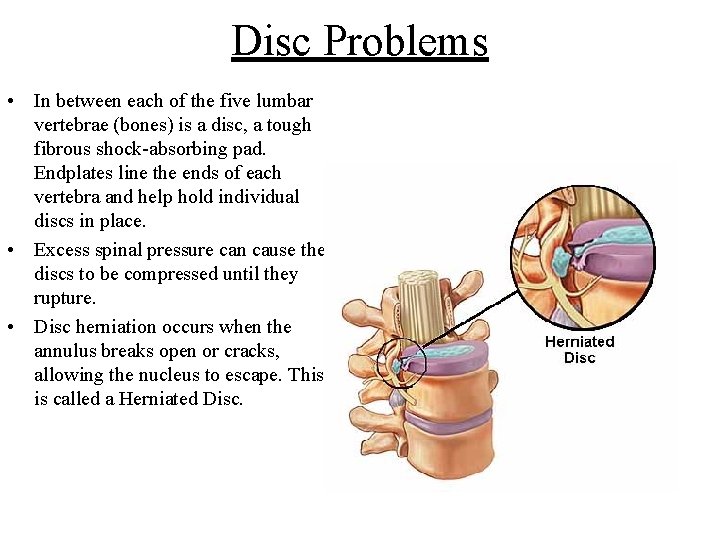 Disc Problems • In between each of the five lumbar vertebrae (bones) is a